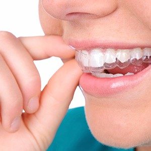 s clearAligners 300x300 - Invisalign Teen