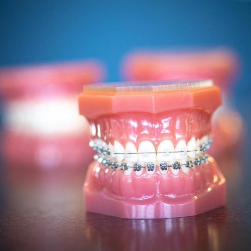 HWH Technology New 7 500x500 - Clear Braces & Ceramic Braces | Topeka Orthodontist - WH Orthodontics