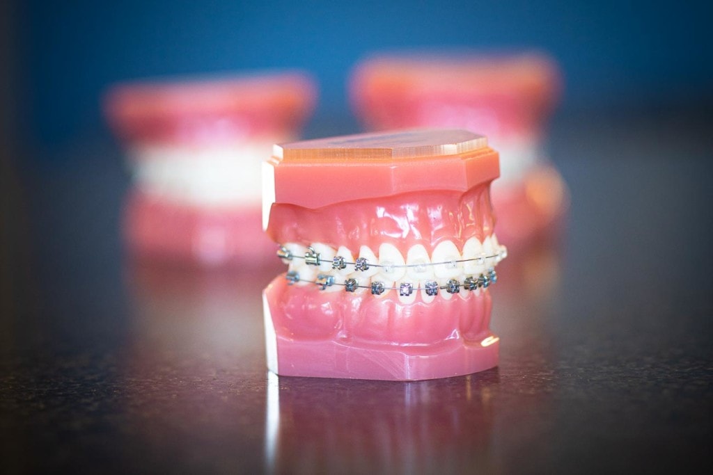 Opciones De Ortodoncia | Topeka Ortodoncista - WH Orthodontics - Opciones De Ortodoncia | Topeka Ortodoncista - WH Orthodontics