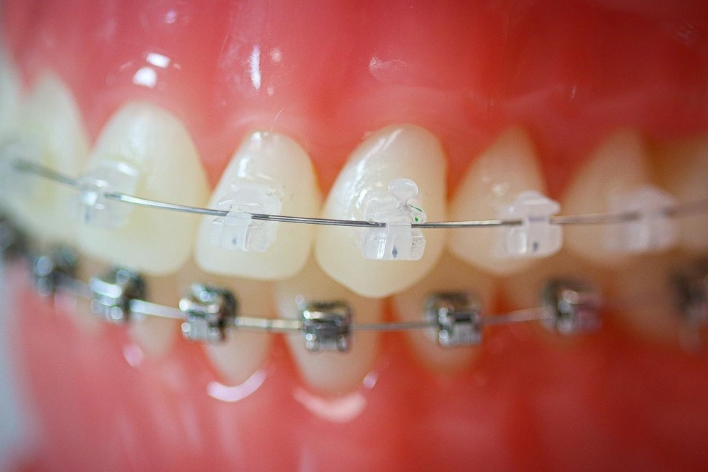 Clear Braces & Ceramic Braces | Topeka Orthodontist - WH Orthodontics - Clear Braces & Ceramic Braces | Topeka Orthodontist - WH Orthodontics