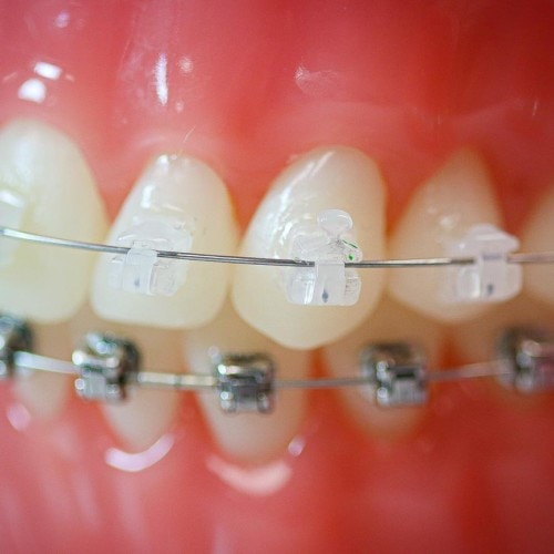 hwh typodonts new 10 500x500 - Clear Braces & Ceramic Braces | Topeka Orthodontist - WH Orthodontics