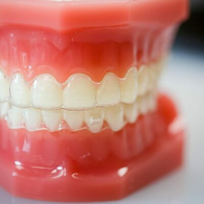 hwh typodonts new 12 400x400 - Braces vs. Invisalign: Which Works for Me?