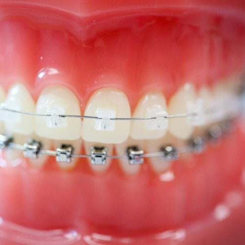 hwh typodonts new 18 500x500 - Clear Braces & Ceramic Braces | Topeka Orthodontist - WH Orthodontics