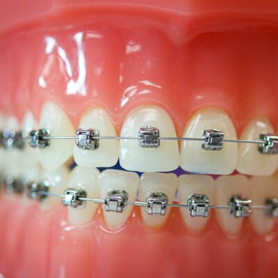 hwh typodonts new 4 400x400 - Braces vs. Invisalign: Which Works for Me?