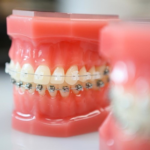 clear metal braces topeka ks