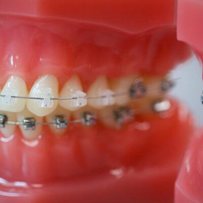 hwh typodonts new 9 400x400 - Braces vs. Invisalign: Which Works for Me?