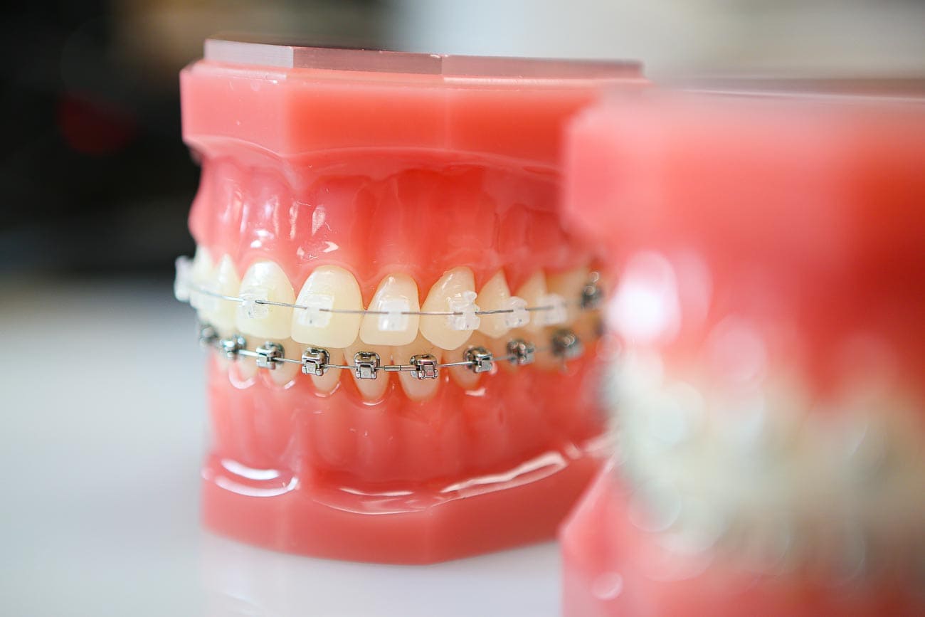 DIY Braces: 5 Ways the Effects Aren’t Safe for Your Smile