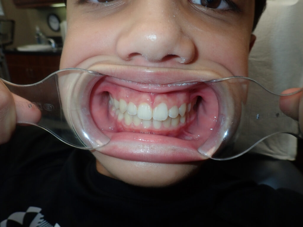 200403 AFTER 1024x768 - Crooked Teeth? Fix Dental Crowding With Invisalign
