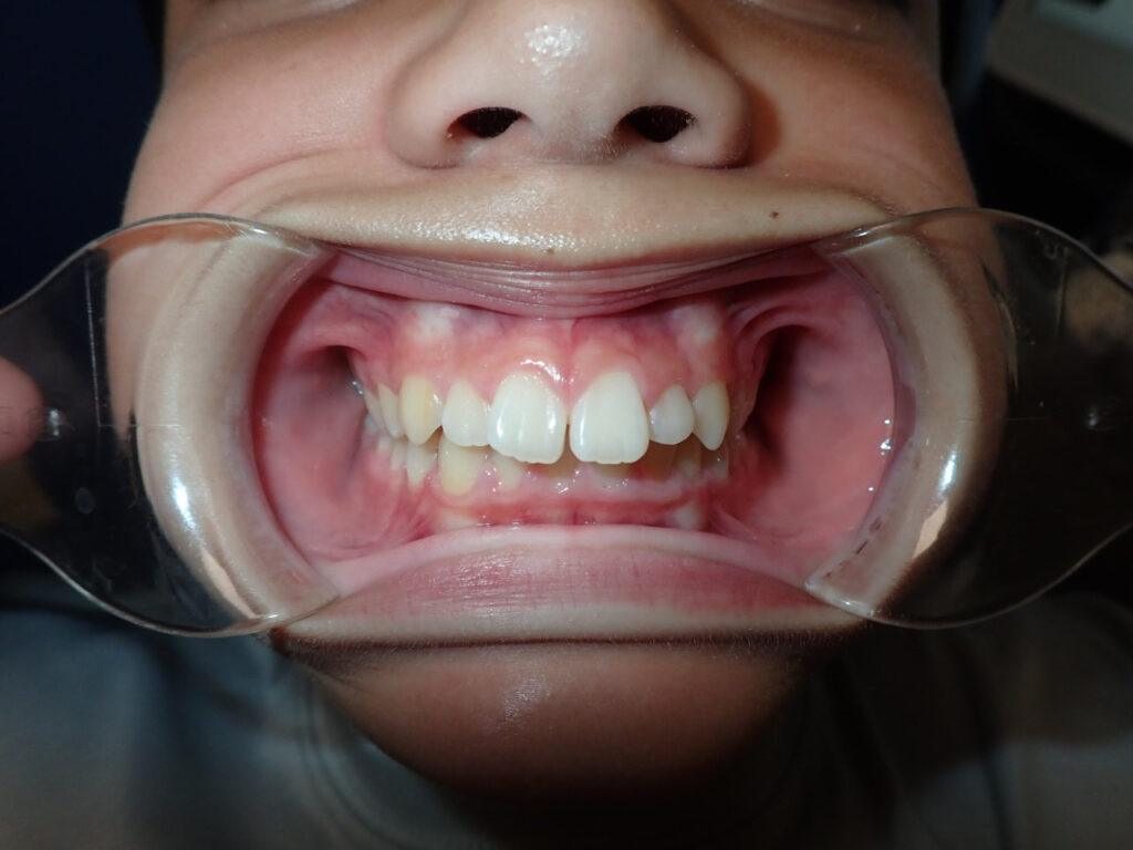 200403 BEFORE 1024x768 - Crooked Teeth? Fix Dental Crowding With Invisalign