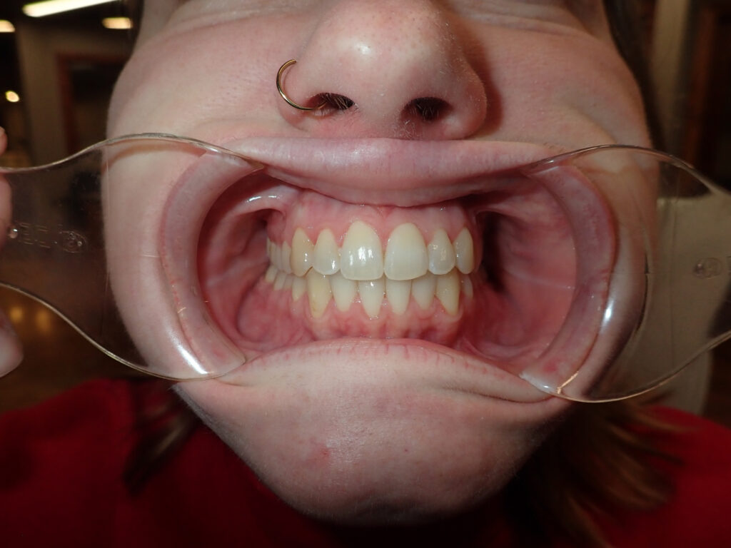 620106 AFTER 1024x768 - Crooked Teeth? Fix Dental Crowding With Invisalign