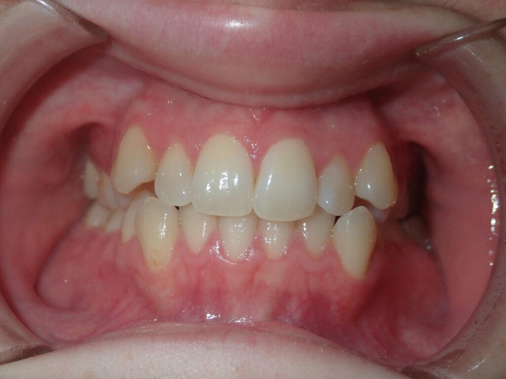 620106 BEFORE 1024x768 - Crooked Teeth? Fix Dental Crowding With Invisalign